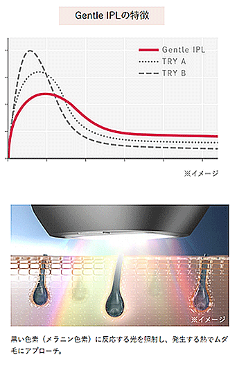肌へのやさしさにこだわったGentle IPL のテクノロジー